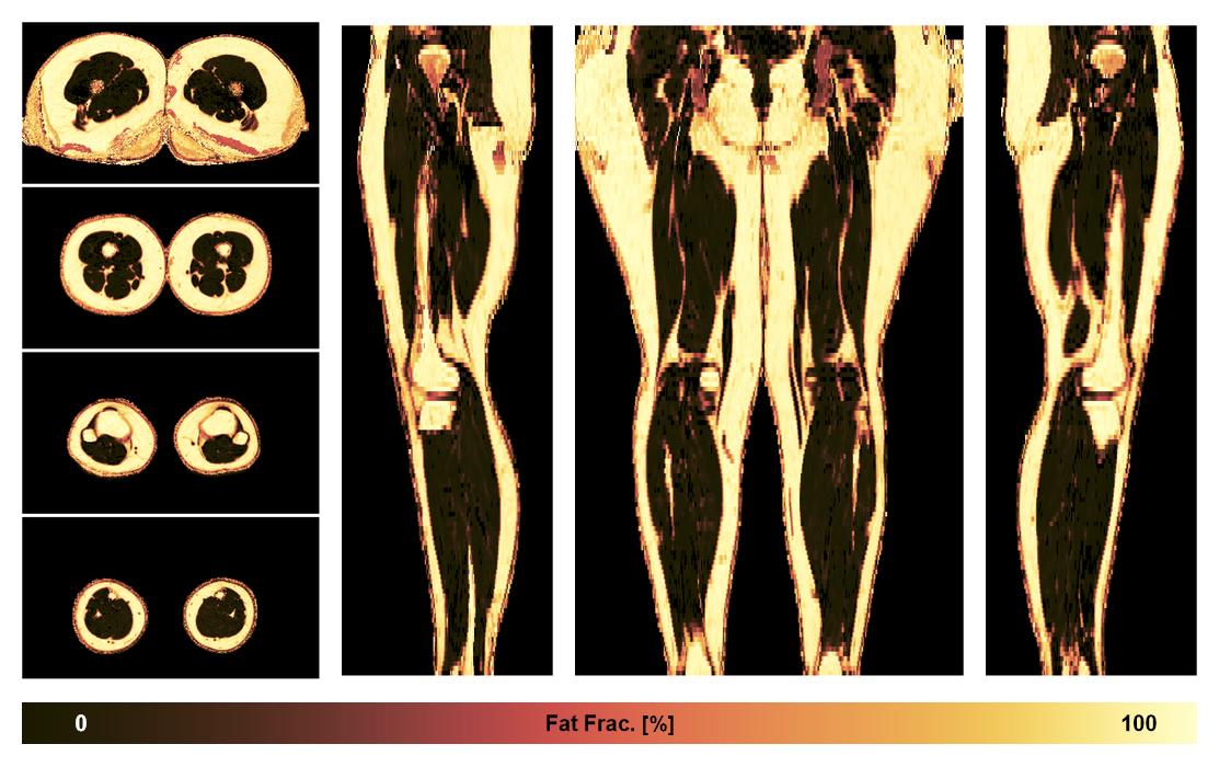 The fat fraction of the lower extremity obtained from the dixon reconstruction for muscle water fat quantification.